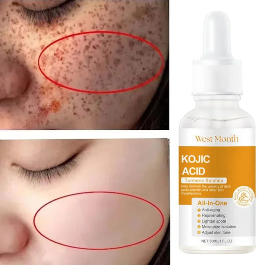 Kojic Acid Freckle Removing Whitening Essence Fade Pigmentation Melasma Dark Spots Corrector Repair Serum Korean Face Skin Care