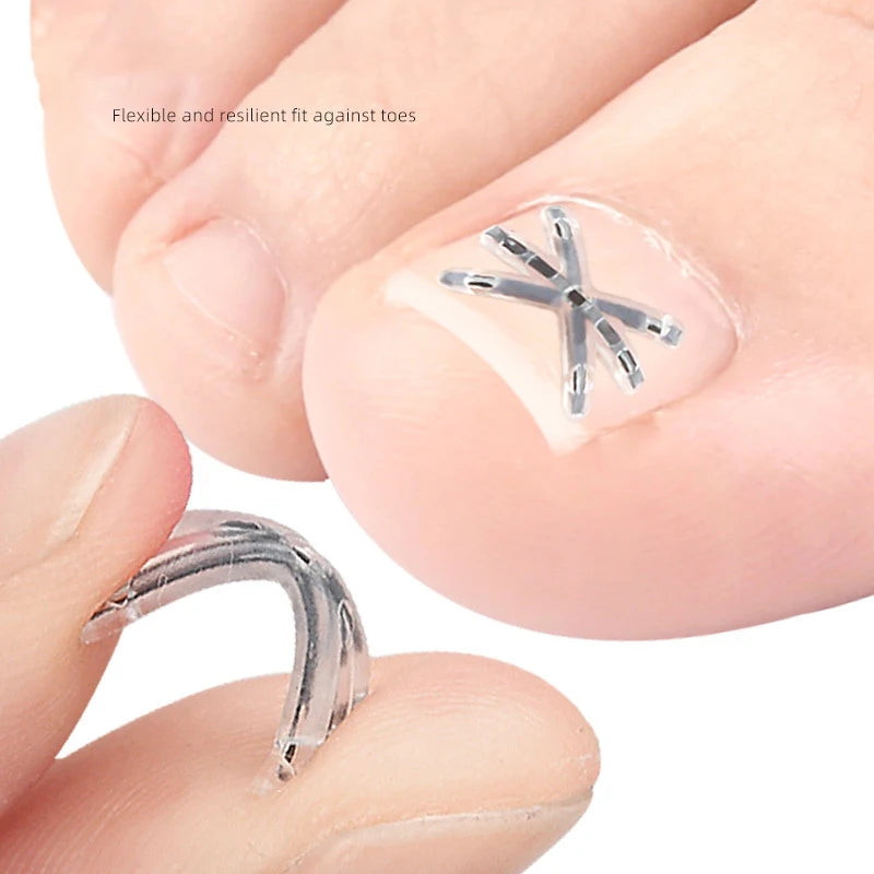 〔San〕2Pcs Ingrown Toenail Correction Tool Ingrown Toenail Treatments Elastic Patch Sticker Toenail Straightening Pedicure Tool