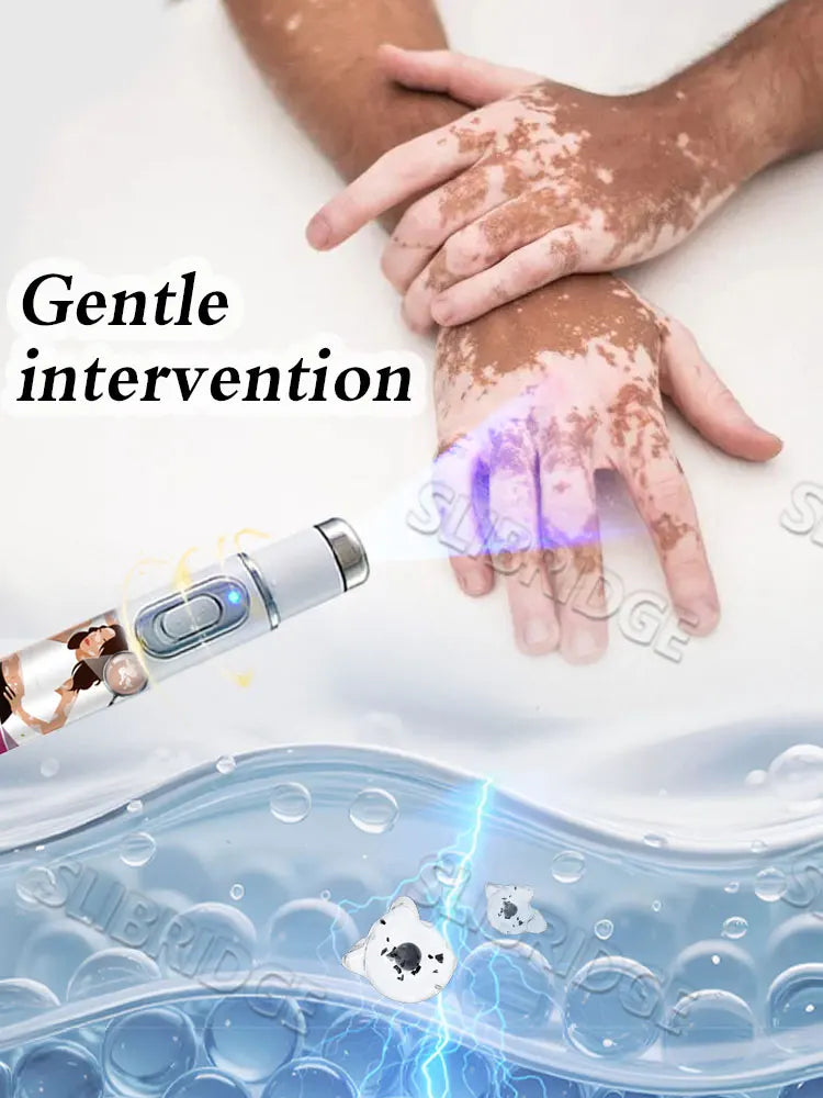 Vitiligo Treatment Device 2nd Upgraded Version⸴Vitiligo Treatment⸴Fast