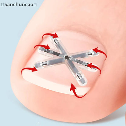 〔San〕2Pcs Ingrown Toenail Correction Tool Ingrown Toenail Treatments Elastic Patch Sticker Toenail Straightening Pedicure Tool