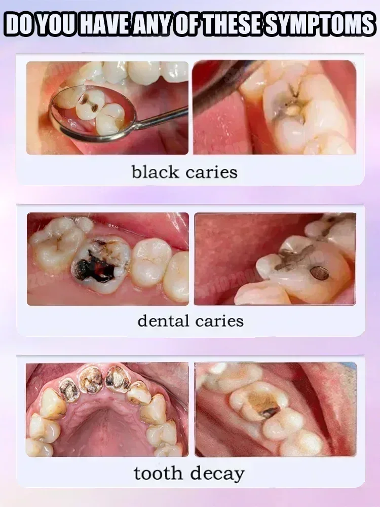 Effective Teeth Whitening Tooth decay repair  Calculus Plaque Periodontitis Remove Cavities