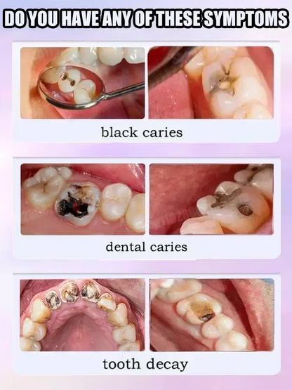 Effective Teeth Whitening Tooth decay repair  Calculus Plaque Periodontitis Remove Cavities