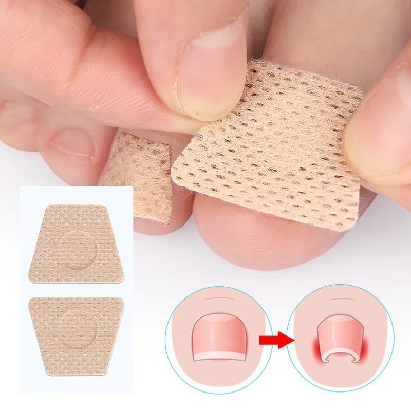 2/6/12Pc Ingrown Toenail Toe Correction Stickers Nail Art Foot Patches Feet Care Paronychia Treatment Recover Pedicure Foot Tool