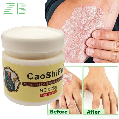20g Psoriasis Cream Dermatitis Eczematoid Treatment Antibacterial Ointment Effective Body Anti-Itch Health Skin Care Products