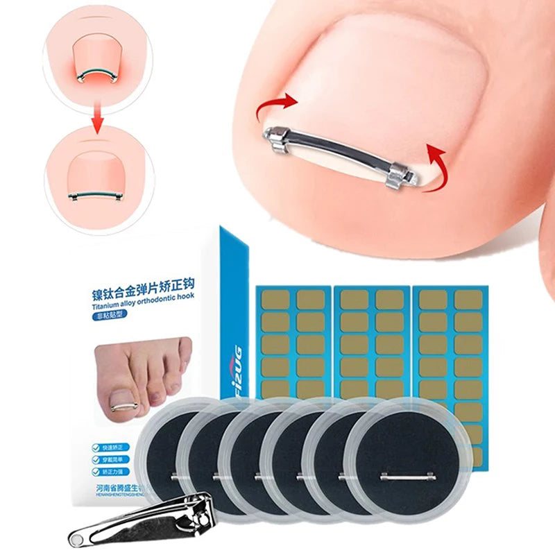 Ingrown Toenail Pedicure Tool Embed Toe Nail Care Straightening Correction Clip Curved Clamp Toenails Correction Tool For Toes