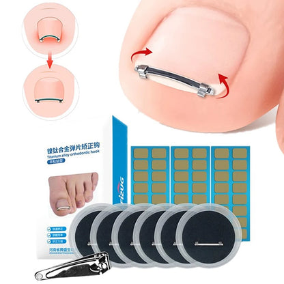 Ingrown Toenail Pedicure Tool Embed Toe Nail Care Straightening Correction Clip Curved Clamp Toenails Correction Tool For Toes