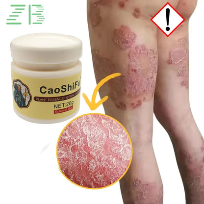 20g Psoriasis Cream Dermatitis Eczematoid Treatment Antibacterial Ointment Effective Body Anti-Itch Health Skin Care Products