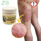 20g Psoriasis Cream Dermatitis Eczematoid Treatment Antibacterial Ointment Effective Body Anti-Itch Health Skin Care Products