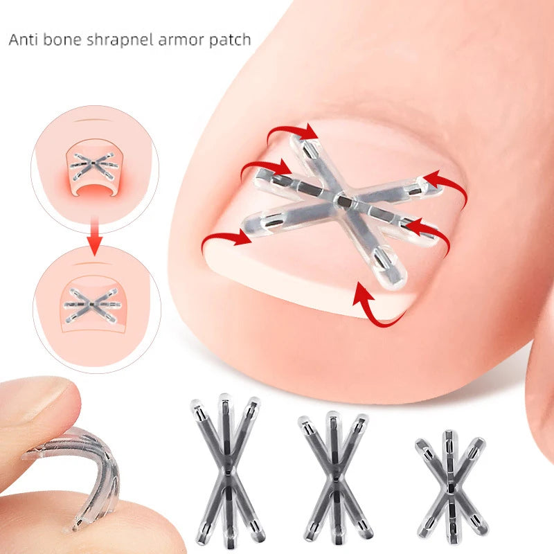 〔San〕2Pcs Ingrown Toenail Correction Tool Ingrown Toenail Treatments Elastic Patch Sticker Toenail Straightening Pedicure Tool