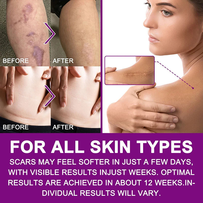 1.5M Silicone Scar Sheets Clear Scars Tape Strip Invisible Silicone Self-adhesive Patches for C-Section Surgery Keloid Burn Acne
