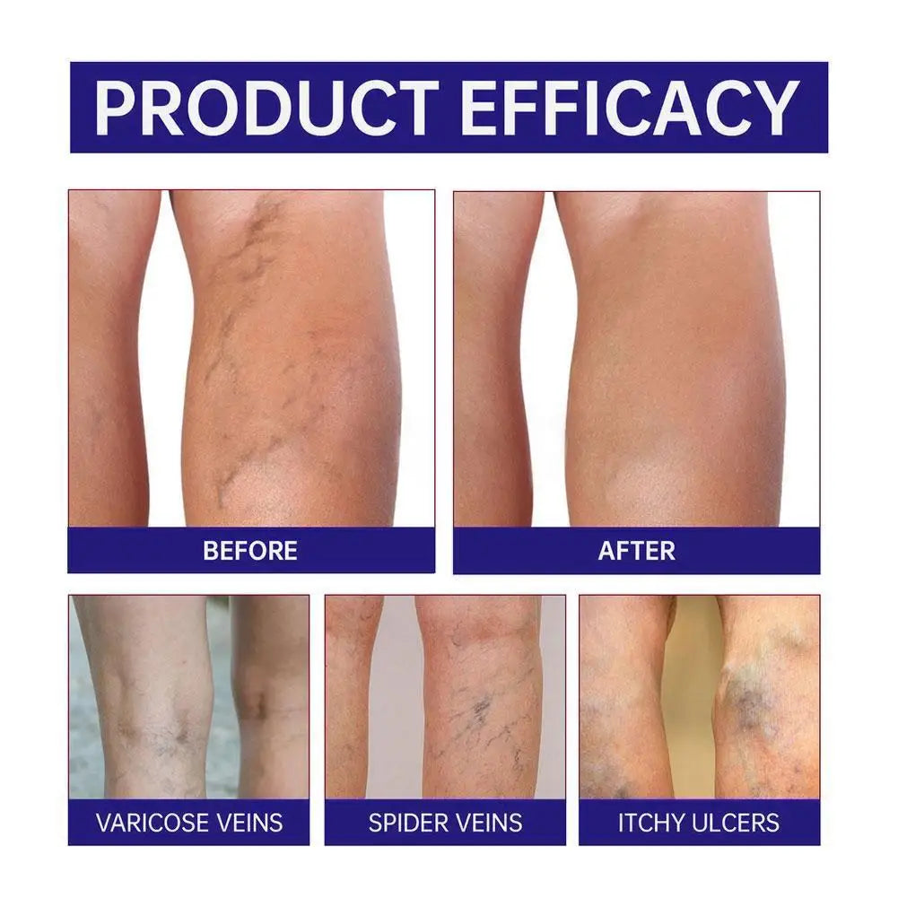 Natural Ingredients Vein Relief Cream for Legs Soothes Aching Varicose Veins Alleviates Swelling - Home Use for Leg Vein Health