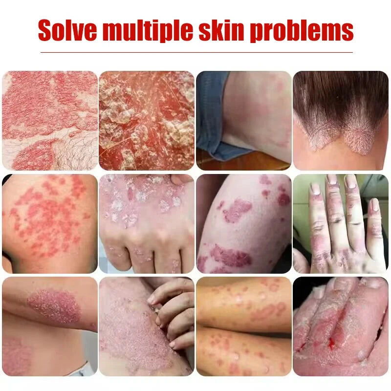 20g Psoriasis Cream Dermatitis Eczematoid Treatment Antibacterial Ointment Effective Body Anti-Itch Health Skin Care Products