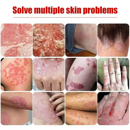 20g Psoriasis Cream Dermatitis Eczematoid Treatment Antibacterial Ointment Effective Body Anti-Itch Health Skin Care Products