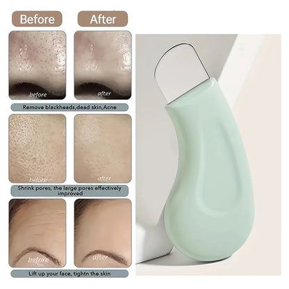 Deep Cleansing Blackhead & Whitehead Removal Tool for Nose and Face - Skin Pore Cleaner Skin Care Beauty Tools Hot Sale