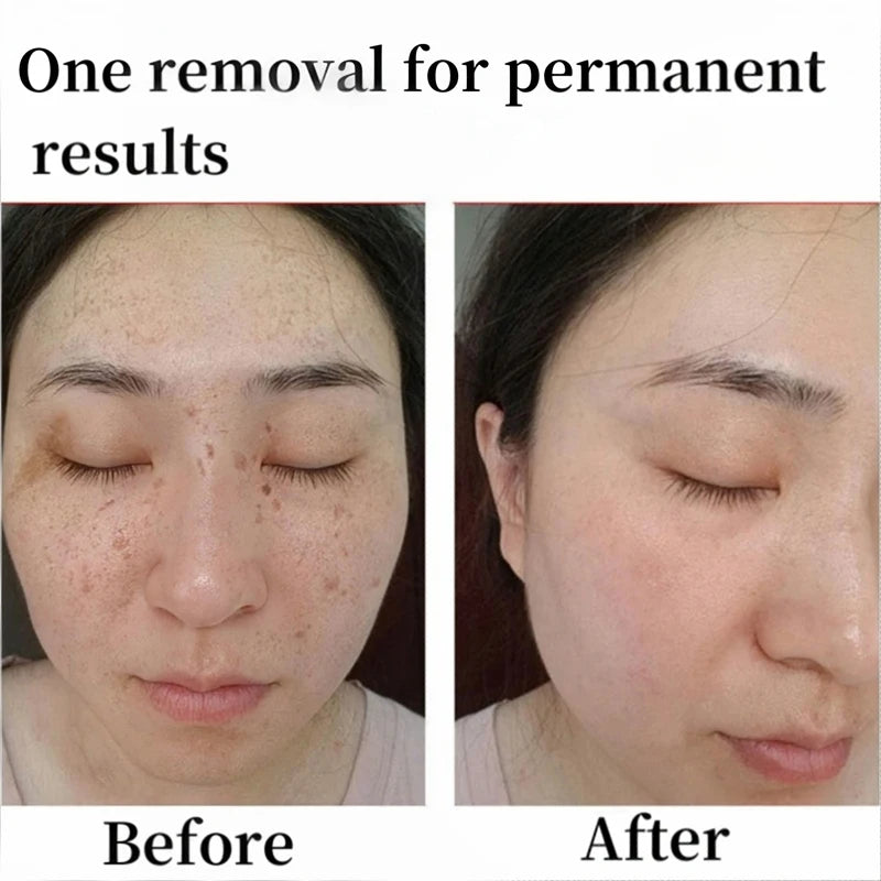 Peel Off Instant Freckle Removal Mask Effective Treatment Chloasma Pigmentation Acne Scars Dark Spots Facial Skin Care Products