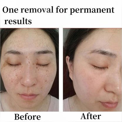 Peel Off Instant Freckle Removal Mask Effective Treatment Chloasma Pigmentation Acne Scars Dark Spots Facial Skin Care Products