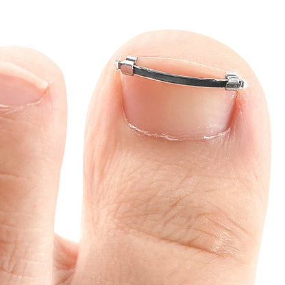 Ingrown Toenail Pedicure Tool Embed Toe Nail Care Straightening Correction Clip Curved Clamp Toenails Correction Tool For Toes