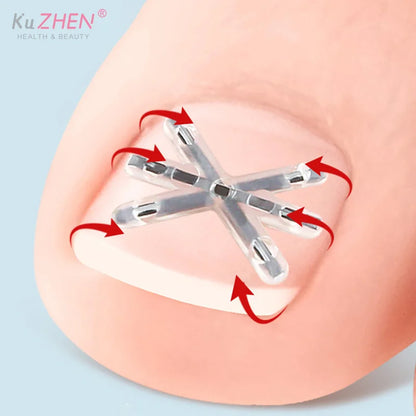 2Pc 13/17MM Ingrown Toenail Correction Tool Ingrown Toenail Treatments Elastic Patch Sticker Toenail Straightening Pedicure Tool