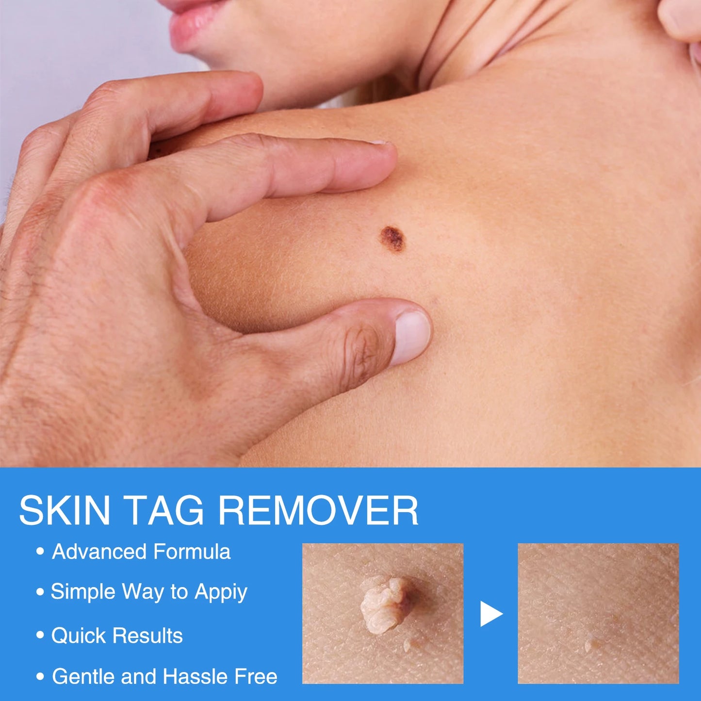 2-IN-1 Innovative Skin Tag Remover Kit Micro Skin Tag Removal Device Adult Mole Stain Wart Remover Face Care Beauty Tools