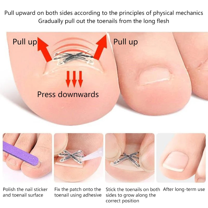 〔San〕2Pcs Ingrown Toenail Correction Tool Ingrown Toenail Treatments Elastic Patch Sticker Toenail Straightening Pedicure Tool