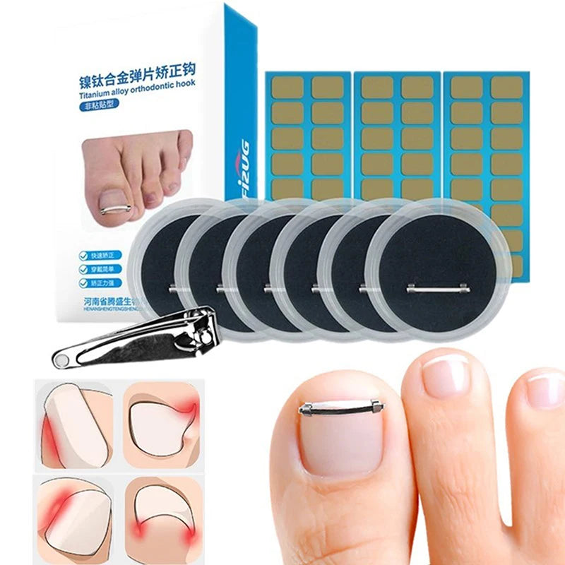 Ingrown Toenail Pedicure Tool Embed Toe Nail Care Straightening Correction Clip Curved Clamp Toenails Correction Tool For Toes