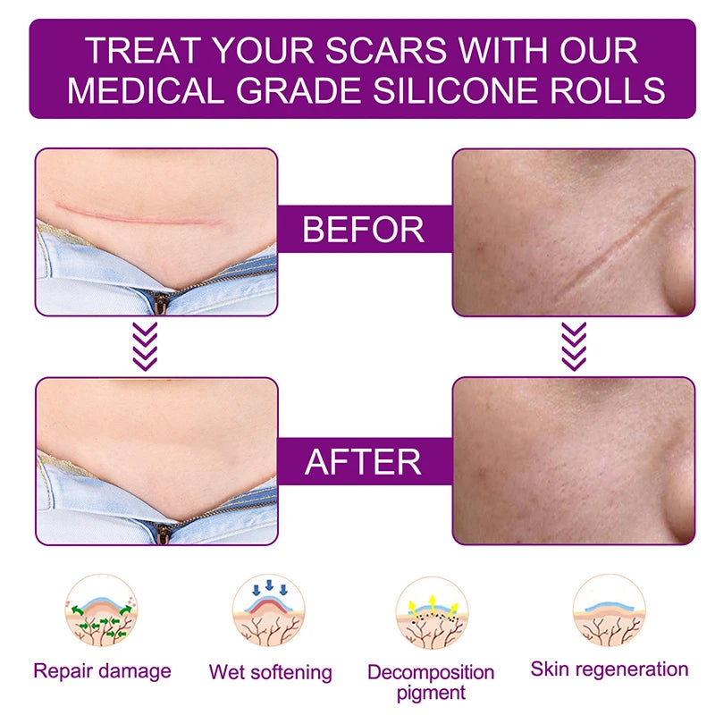 1.5M Silicone Scar Sheets Clear Scars Tape Strip Invisible Silicone Self-adhesive Patches for C-Section Surgery Keloid Burn Acne