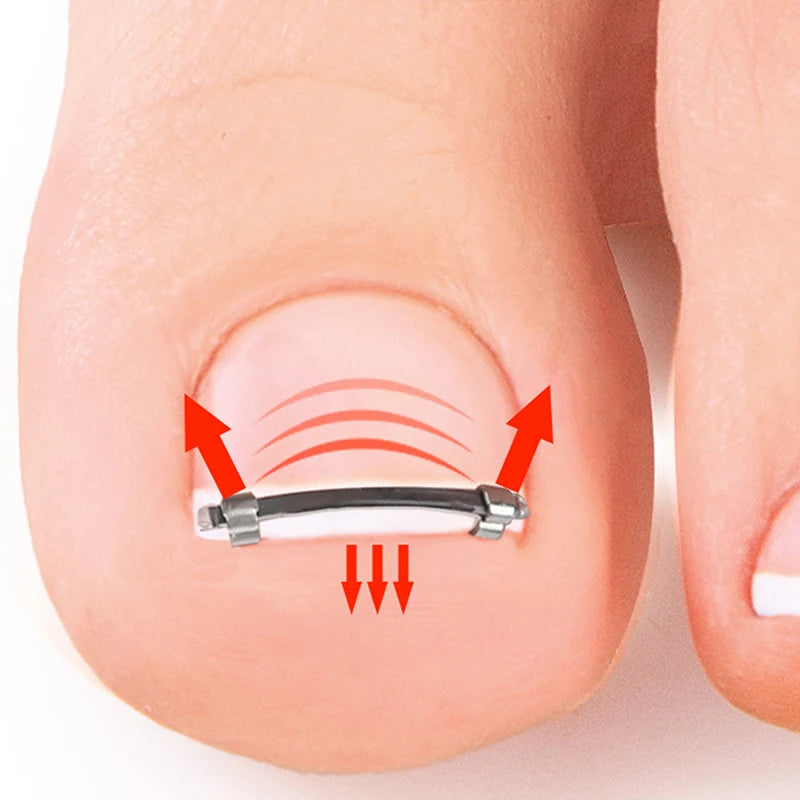 Ingrown Toenail Pedicure Tool Embed Toe Nail Care Straightening Correction Clip Curved Clamp Toenails Correction Tool For Toes