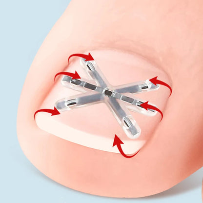 〔San〕2Pcs Ingrown Toenail Correction Tool Ingrown Toenail Treatments Elastic Patch Sticker Toenail Straightening Pedicure Tool