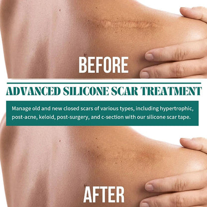 Z. 1 Roll Silicone Scar Sheets Gel Scar Patch 4cmX150cm Self-Adhesive Scar Cover Tape Reusable And Effective Skin Care Strips
