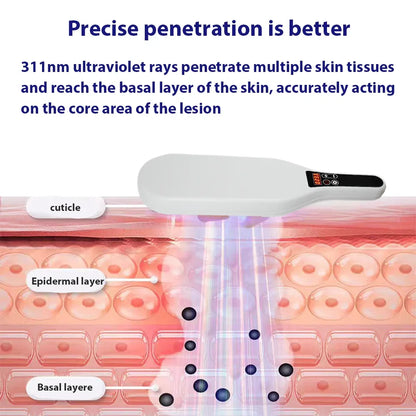 311nm Ultraviolet Phototherapy Instrument Double Lamp UVB Lamp for Vitiligo Treatment Psoriasis Lamp Skin Disease Device
