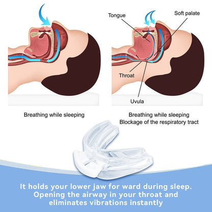 Anti Snoring Bruxism Mouth Guard Improve Sleeping Teeth Bruxism Sleep Aid Anti-Snore and Apnea Device To Stop Snoring