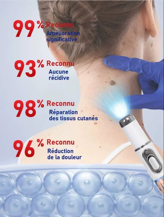 The latest generation of blue light wart removal pen quickly eliminates warts.