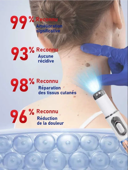The latest generation of blue light wart removal pen quickly eliminates warts.
