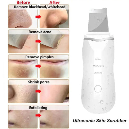 Ultrasonic Skin Scrubber Peeling Blackhead Remover Deep Face Cleaning Acne Pore Cleaner Facial Shovel Cleanser EMS Microcurrent