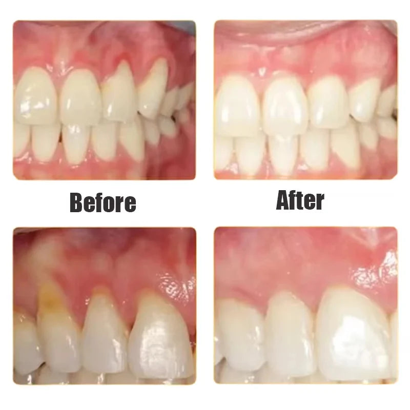 Damaged Gum Repair Care Gel Serum Relieve Sore Gums Allergy Deep Cleaning Teeth Stains Tartar Serum Dental Caries Tooths Serum