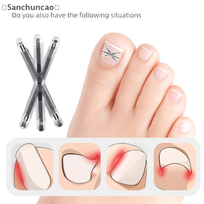 〔San〕2Pcs Ingrown Toenail Correction Tool Ingrown Toenail Treatments Elastic Patch Sticker Toenail Straightening Pedicure Tool