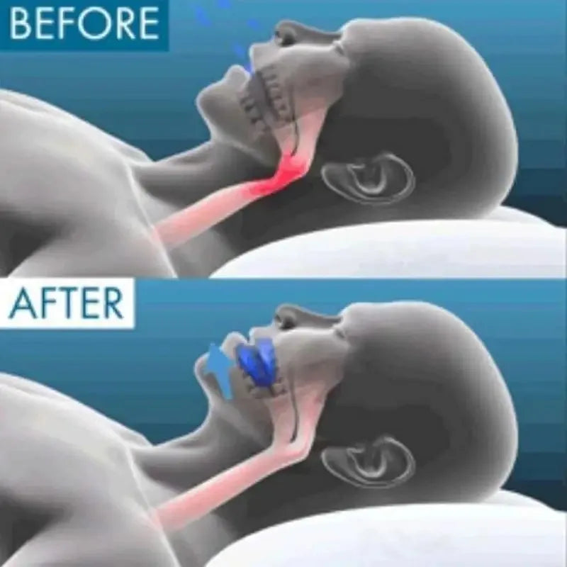 Anti Snoring Mouthpiece Reusable Snore Device Stopper Reduce Snoring Aid Snore Solution For Comfort Easy Breathing