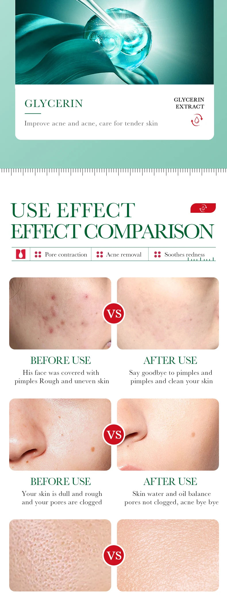 35ml BIOAOUA Salicylic Acid Anti-Acne Removal Essence Regulate Oil Secretion Improve Acne Of Skin Smooth Skin Blackhead Removal
