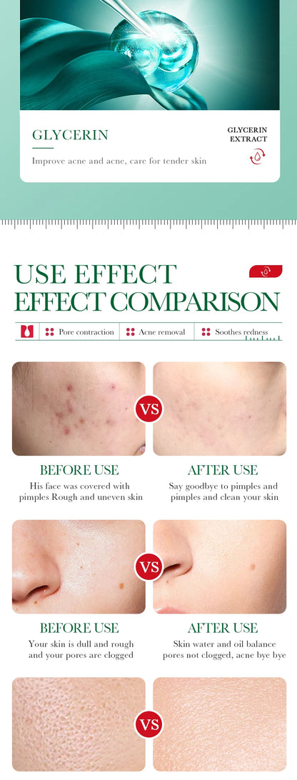 35ml BIOAOUA Salicylic Acid Anti-Acne Removal Essence Regulate Oil Secretion Improve Acne Of Skin Smooth Skin Blackhead Removal