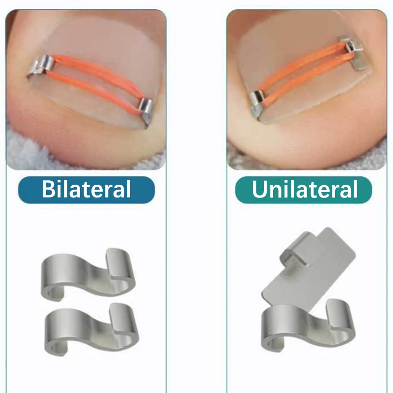 Toenail Correction Foot Care Tool Ingrown Toenail Corrector Tools Pedicure Recover Embed Toe Nail Treatment Professional