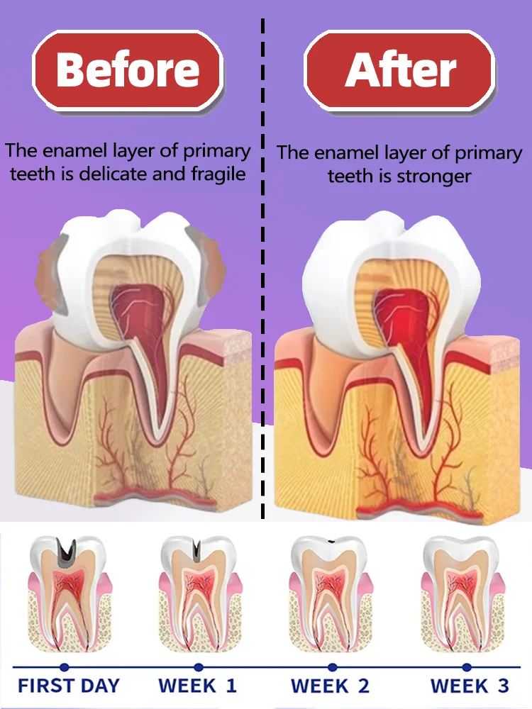Tooth decay Repair Repairing Cavities Protecting Anti Caries