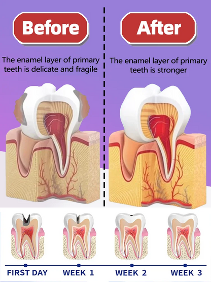 Tooth decay Repair Repairing Cavities Protecting Anti Caries