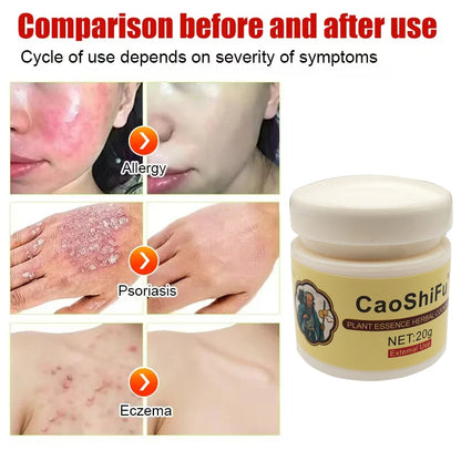 20g Psoriasis Cream Dermatitis Eczematoid Treatment Antibacterial Ointment Effective Body Anti-Itch Health Skin Care Products