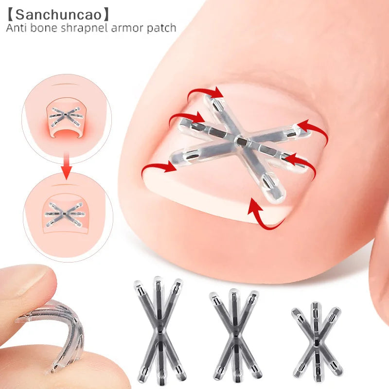 〔San〕2Pcs Ingrown Toenail Correction Tool Ingrown Toenail Treatments Elastic Patch Sticker Toenail Straightening Pedicure Tool