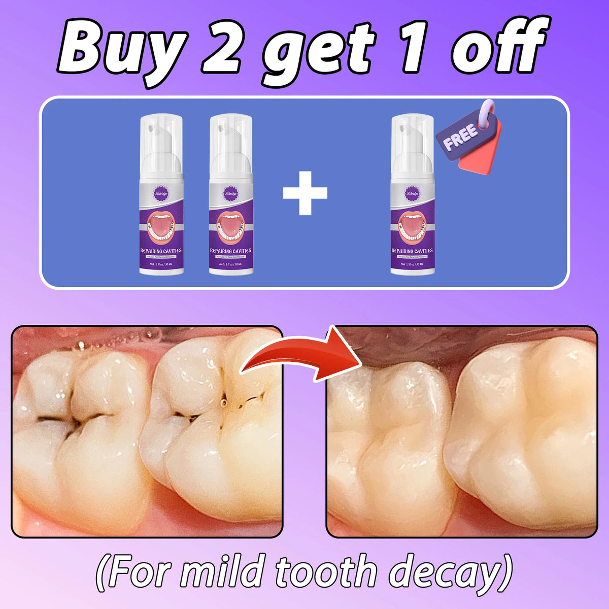 Tooth decay Repair Repairing Cavities Protecting Anti Caries
