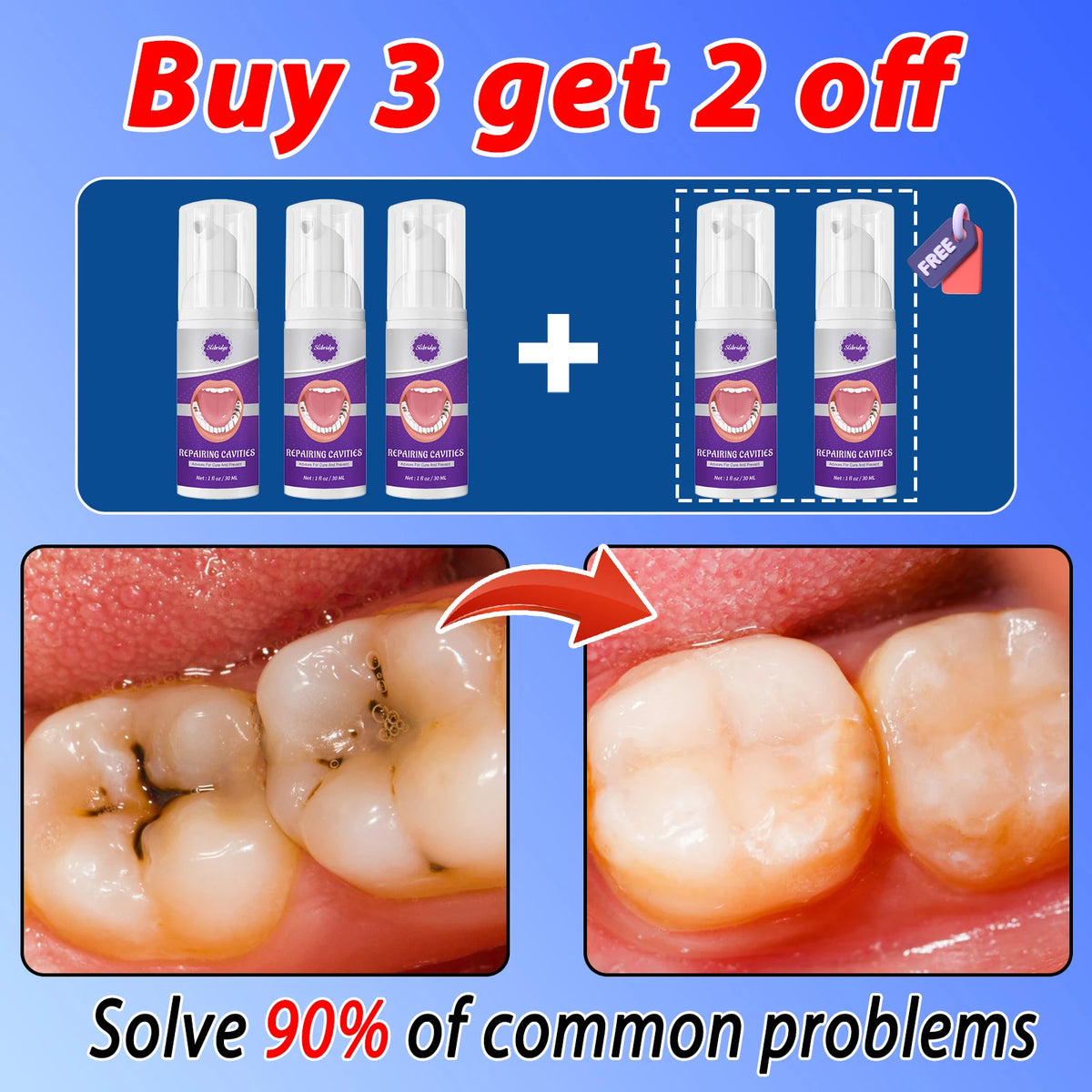 Tooth decay Repair Repairing Cavities Protecting Anti Caries