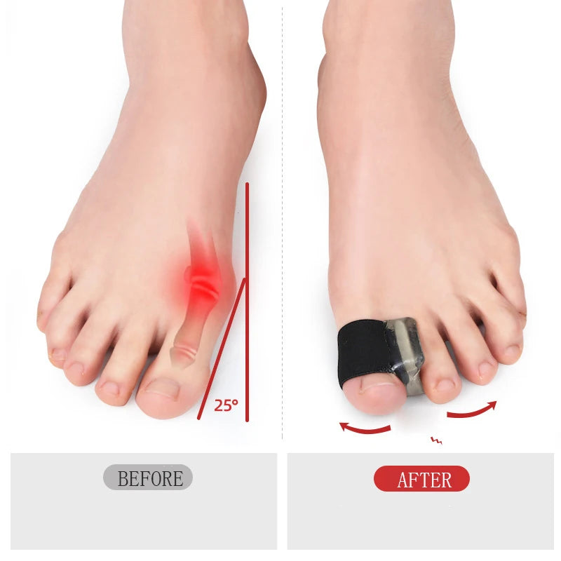 2PCS Big Bone Thumb Toe Separator Bunion Splint Straightener Corrector Foot Care Tools Hallux Valgus Protector Orthotics 1 Pair