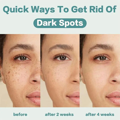 Powerful Spot-removing Whiten Cream Brighten Skin Fast Eliminates Melanin Pigmentation Melasma Dark Spots Moisturize Beauty Gel