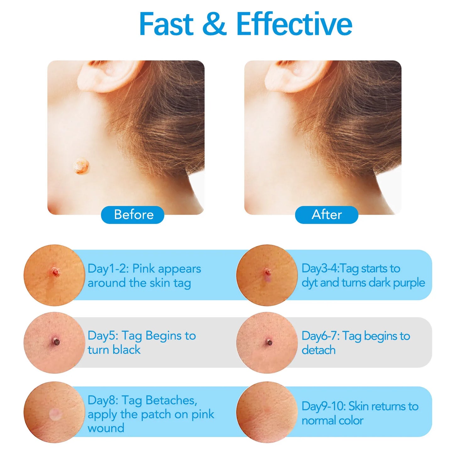 2-IN-1 Innovative Skin Tag Remover Kit Micro Skin Tag Removal Device Adult Mole Stain Wart Remover Face Care Beauty Tools