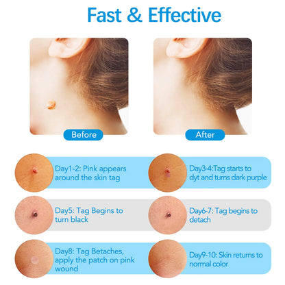 2-IN-1 Innovative Skin Tag Remover Kit Micro Skin Tag Removal Device Adult Mole Stain Wart Remover Face Care Beauty Tools